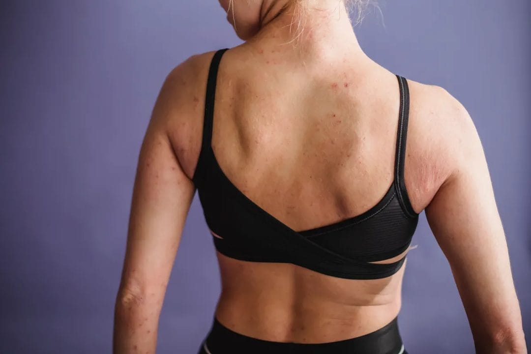 Body Acne in Summer: What's Actually Triggering Bacne, and How to Clear It